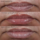 Novexpert - Lip Volumizing treatment